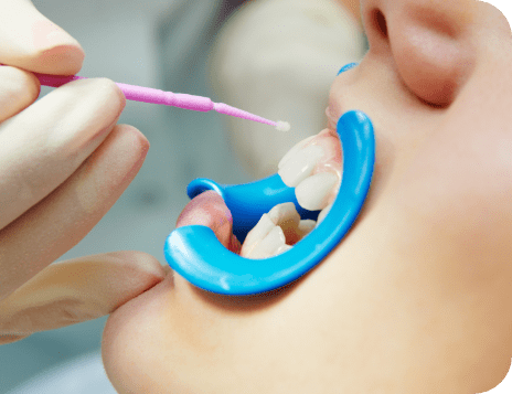 dental sealants