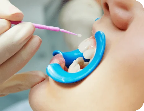 dental sealants